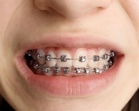 todo sobre los brackets metalicos|brackets de metal.